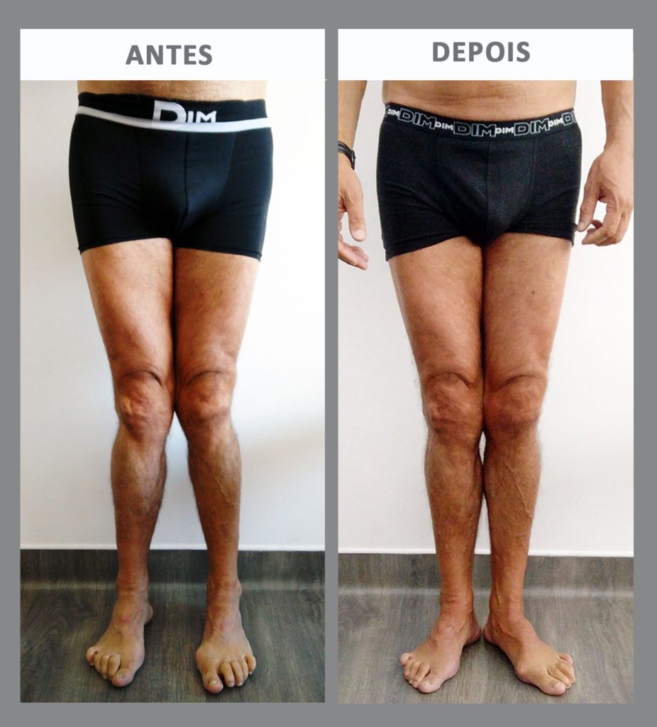 Cirurgia Joelho Valgo Antes E Depois - RETOEDU